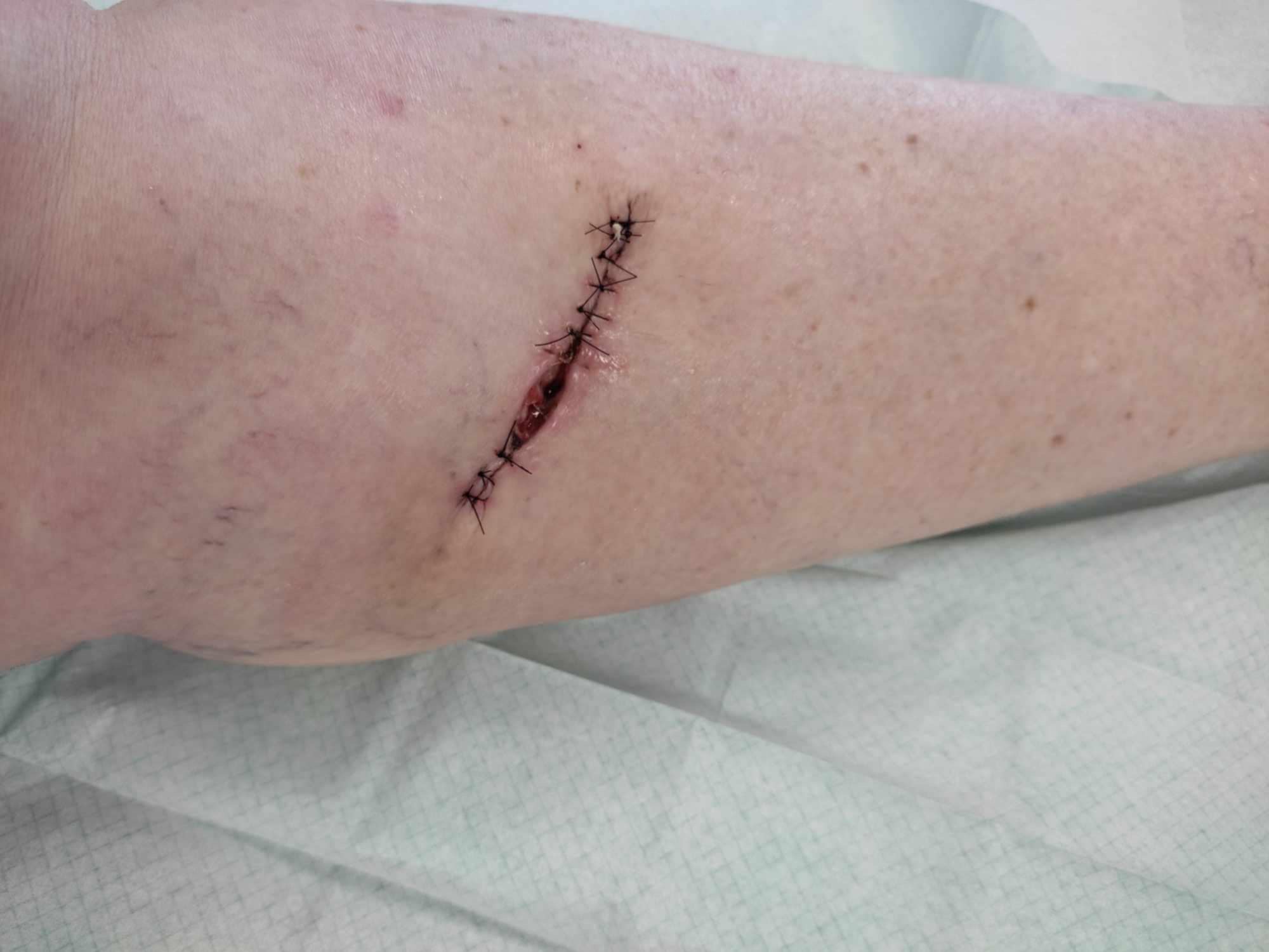 Cicatrice avant traitement